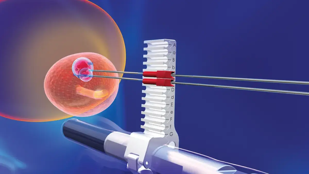Guía transperineal para el tratamiento focal del cáncer de próstata