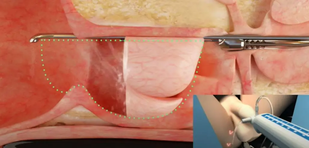Sistema robótico Aquabeam para la hiperplasia benigna de próstata
